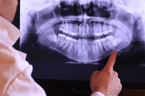 Best Emergency Dentist for Lost Fillings or Crowns in Occidental, CA